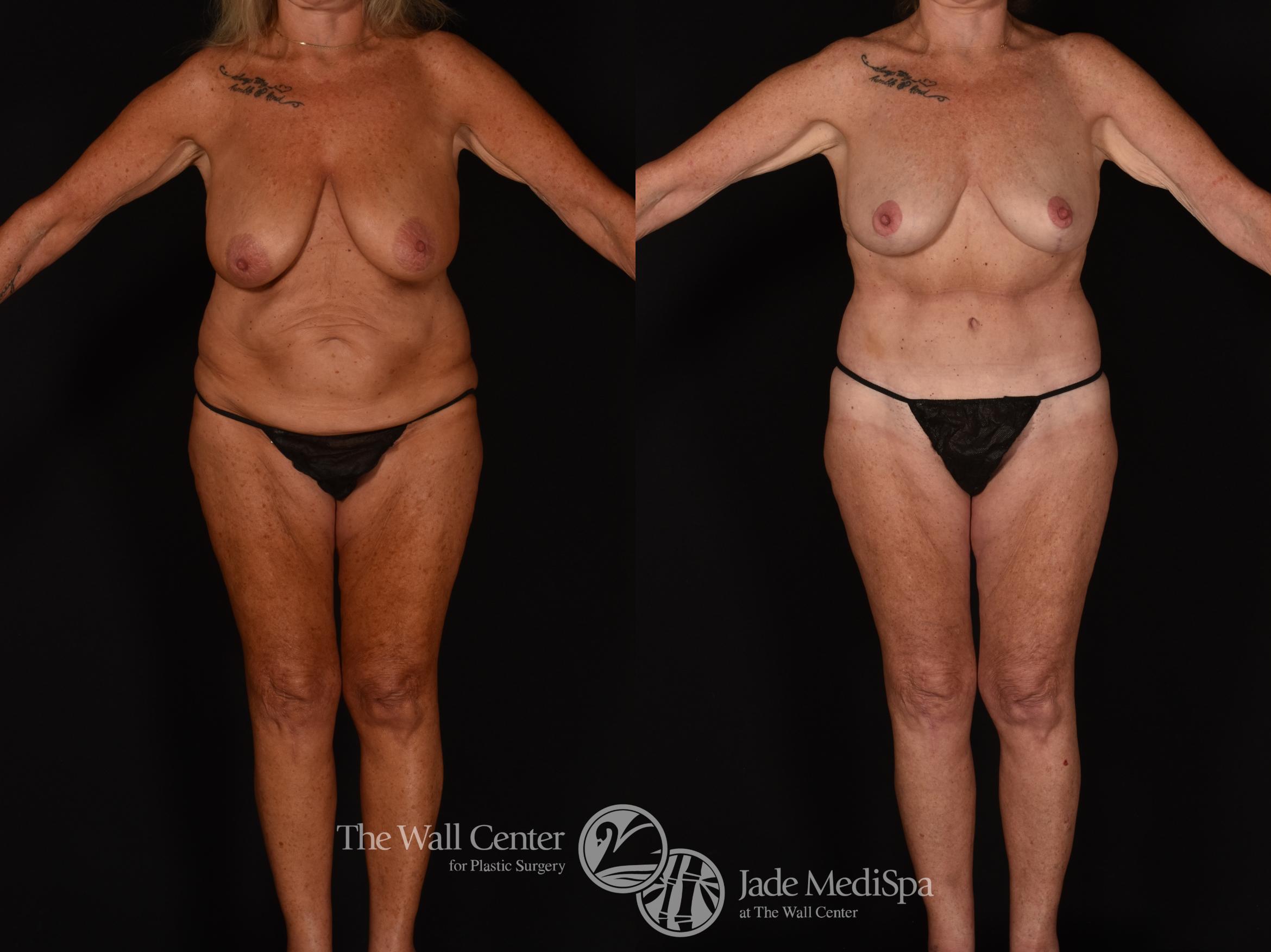 Before & After Tummy Tuck Case 1171 Front View in Shreveport, LA