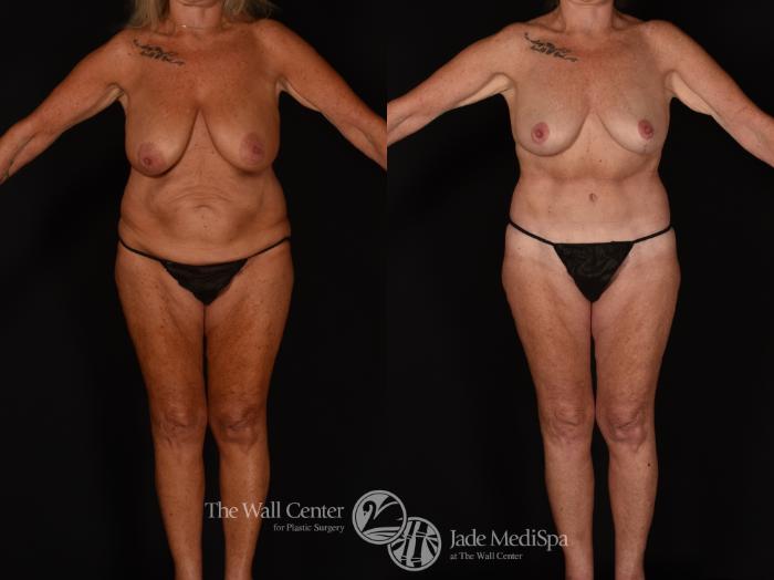 Before & After Tummy Tuck Case 1171 Front View in Shreveport, LA