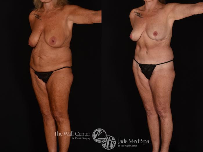Before & After Tummy Tuck Case 1171 Left Oblique View in Shreveport, LA