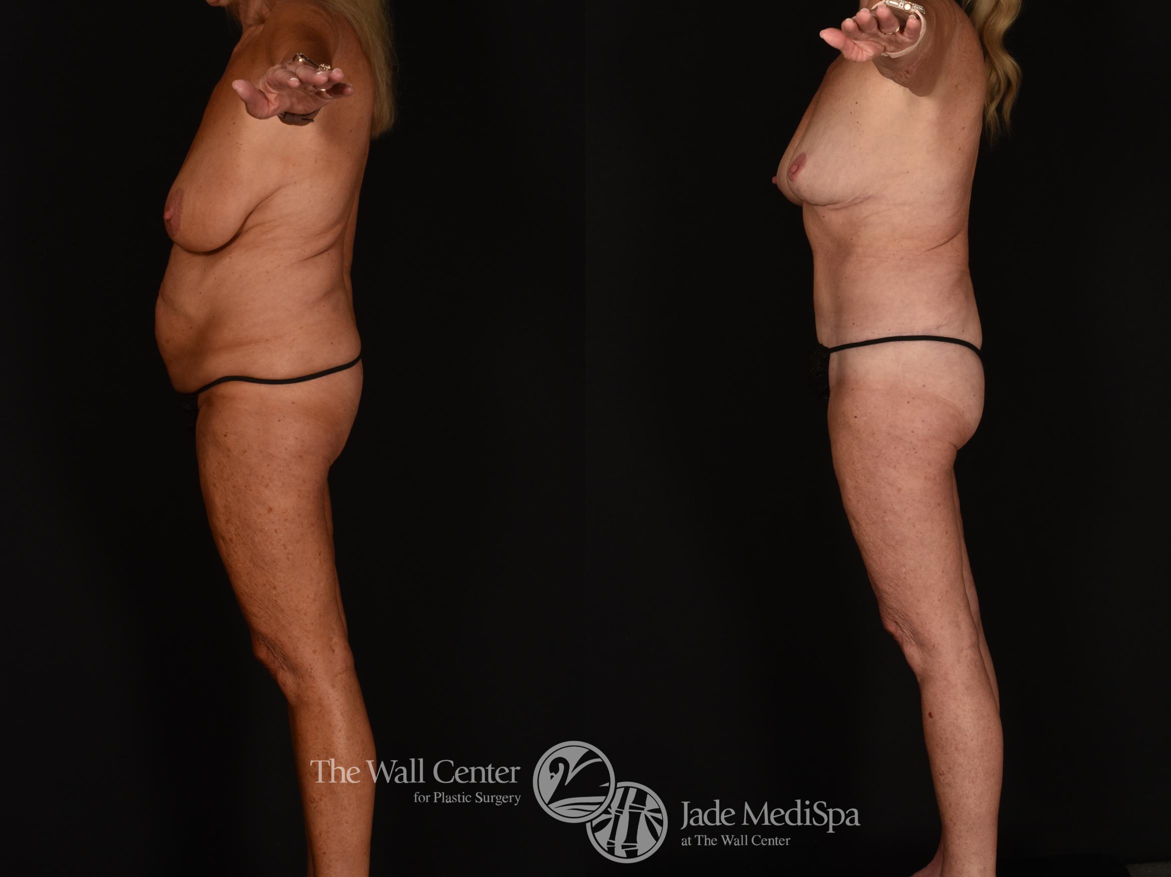Before & After Tummy Tuck Case 1171 Left Side View in Shreveport, LA
