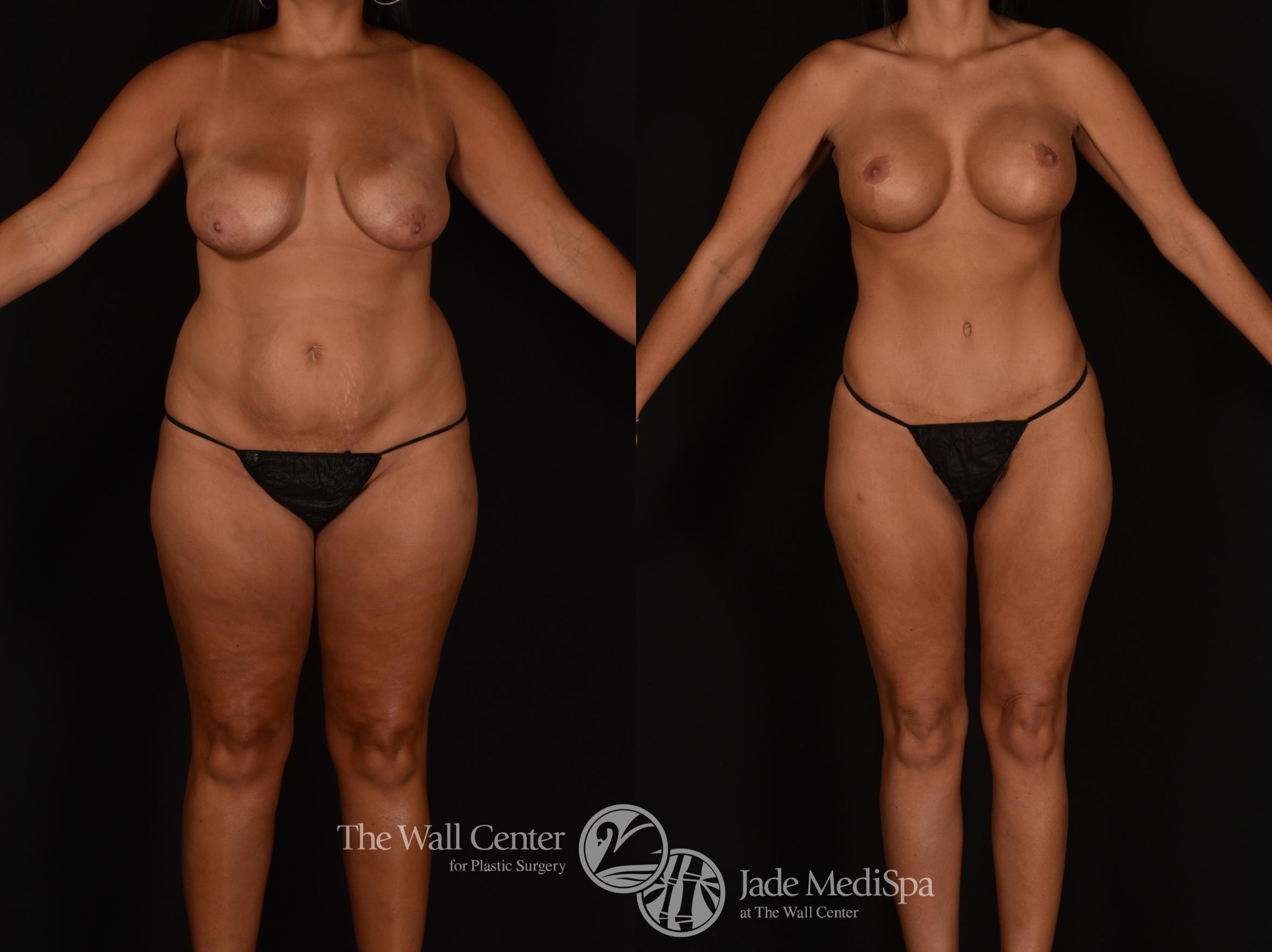 Before & After Tummy Tuck Case 1185 Front View in Shreveport, LA