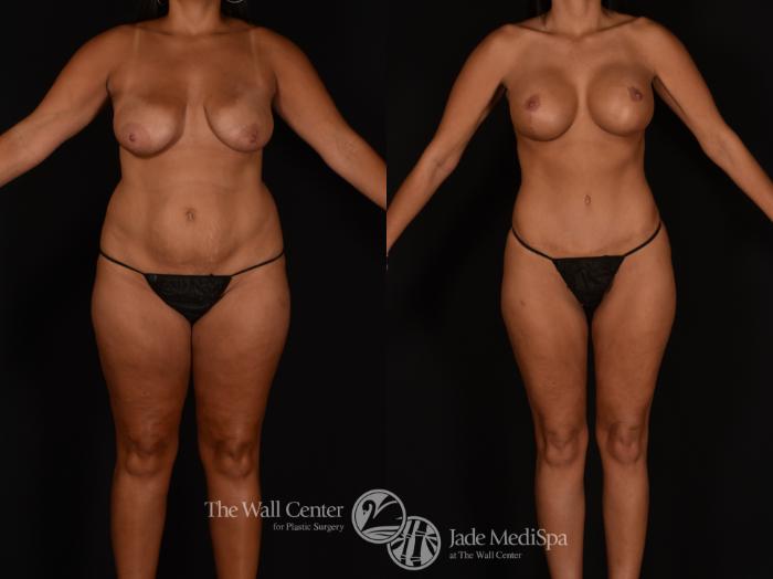 Before & After Tummy Tuck Case 1185 Front View in Shreveport, LA