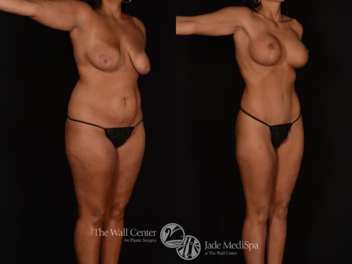 Before & After Tummy Tuck Case 1185 Right Oblique View in Shreveport, LA