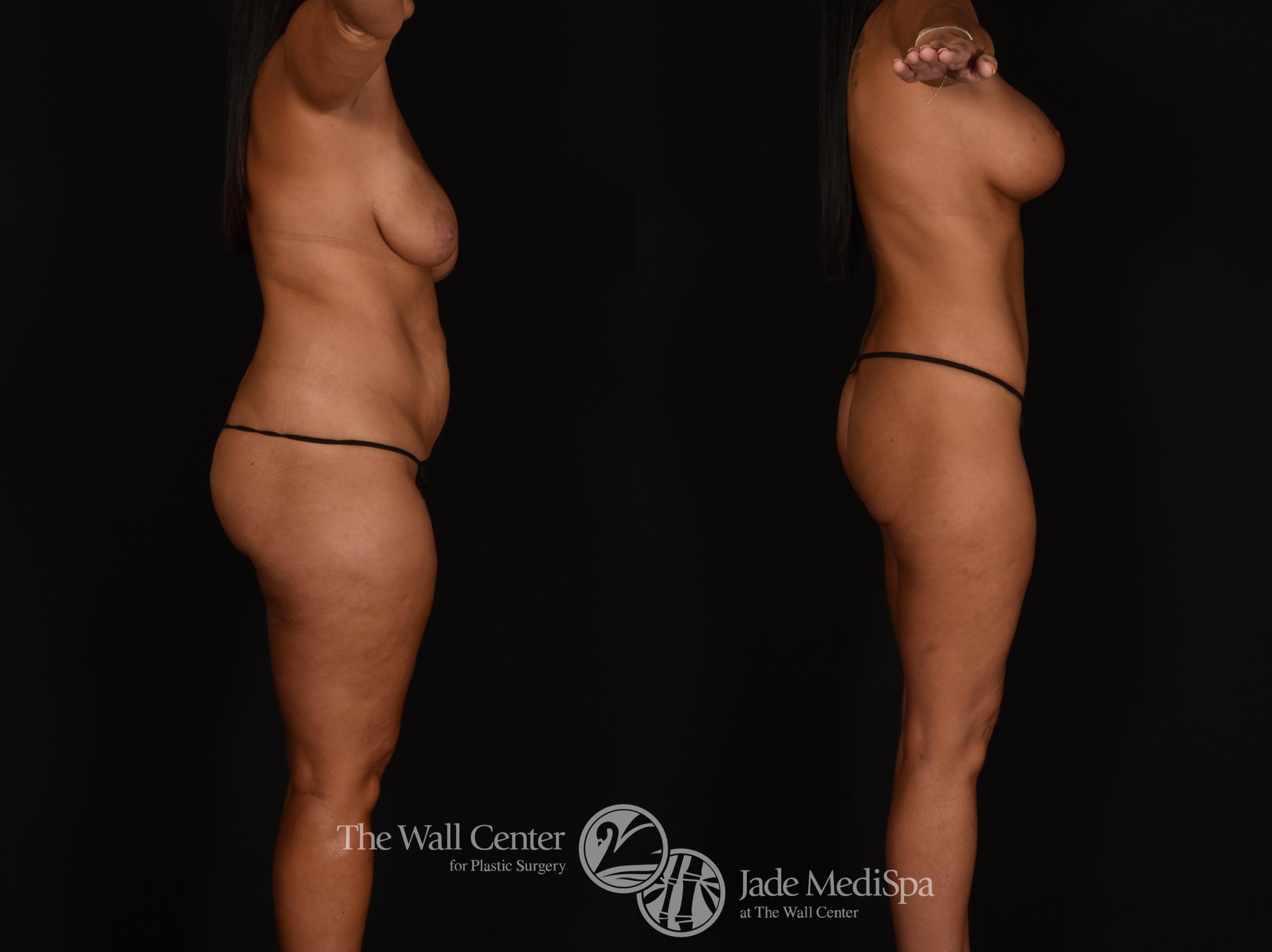 Before & After Tummy Tuck Case 1185 Right Side View in Shreveport, LA