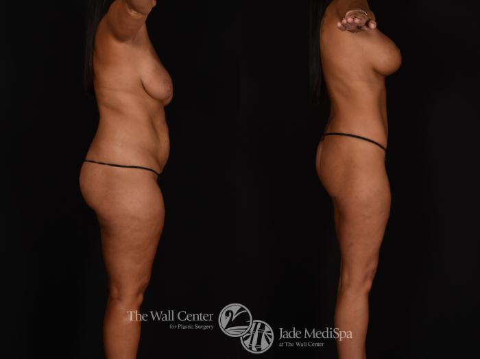 Before & After Tummy Tuck Case 1185 Right Side View in Shreveport, LA