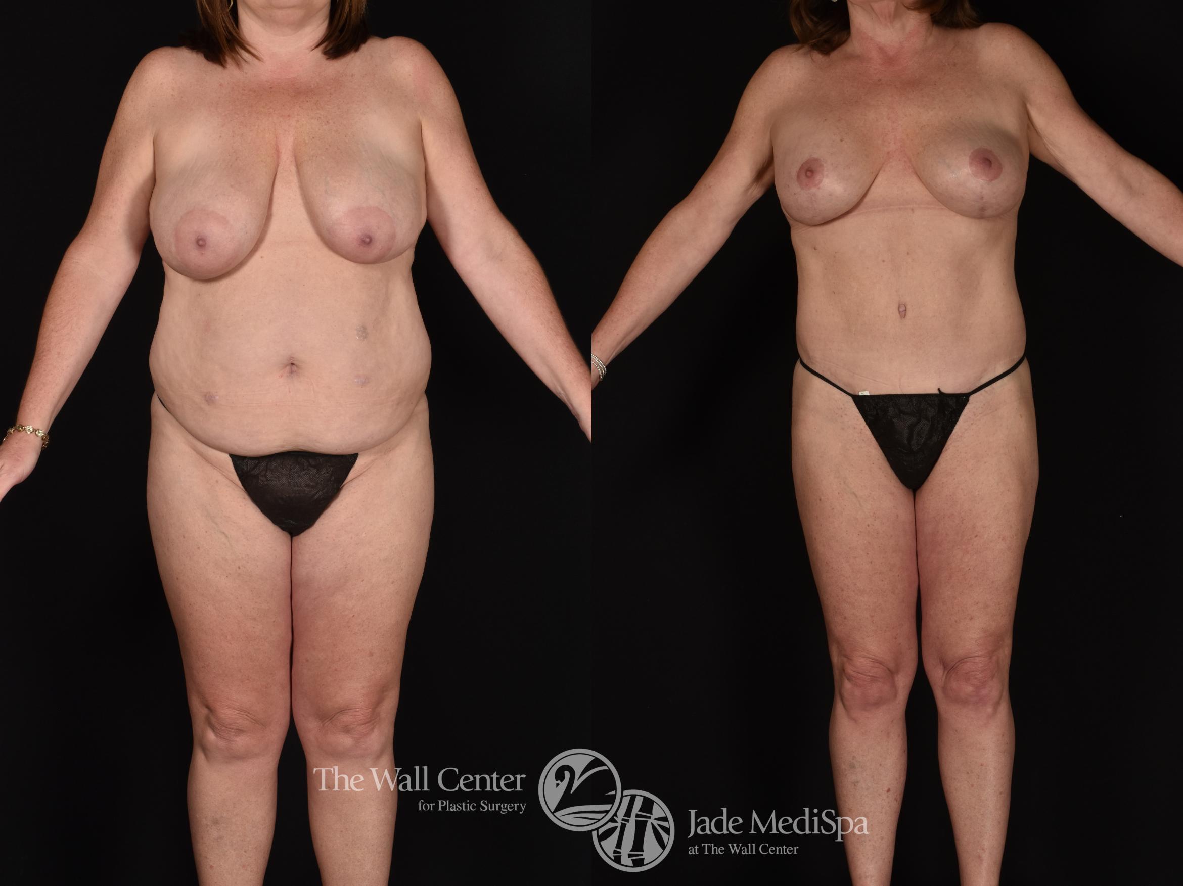 Before & After Tummy Tuck Case 1212 Front View in Shreveport, LA