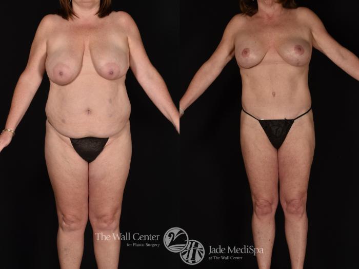 Before & After Tummy Tuck Case 1212 Front View in Shreveport, LA