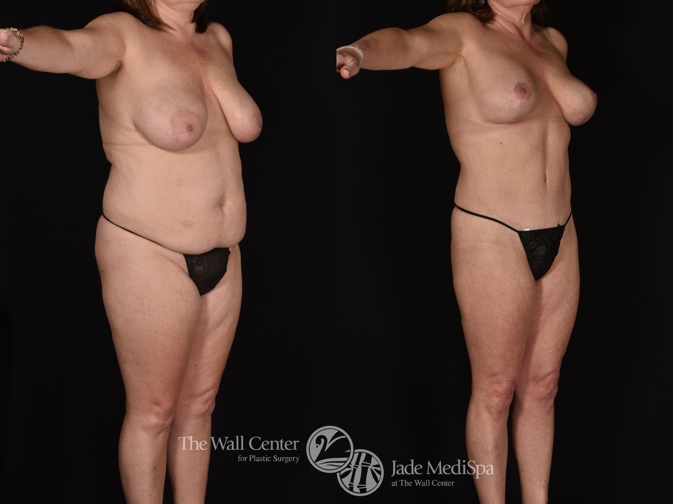 Before & After Tummy Tuck Case 1212 Right Oblique View in Shreveport, LA