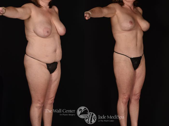 Before & After Tummy Tuck Case 1212 Right Oblique View in Shreveport, LA