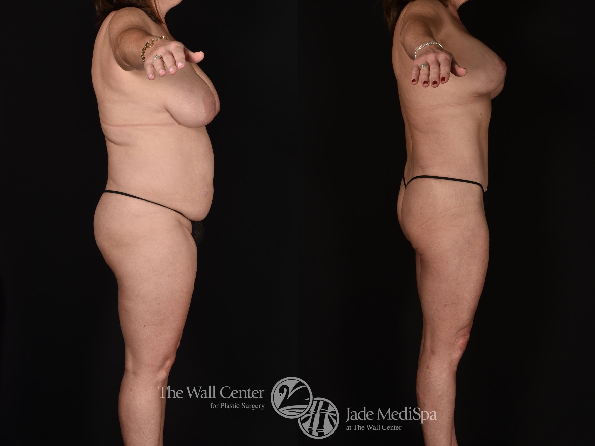 Before & After Tummy Tuck Case 1212 Right Side View in Shreveport, LA