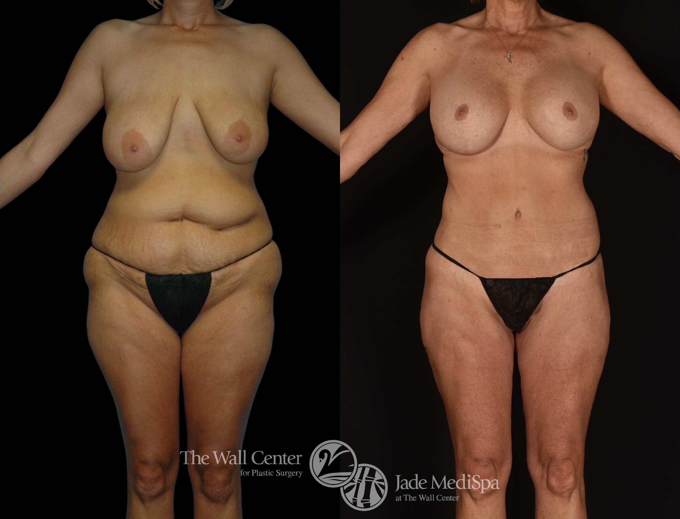 Before & After Tummy Tuck Case 1248 Front View in Shreveport, LA