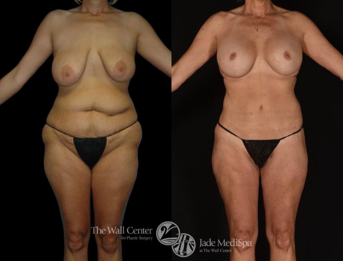 Before & After Tummy Tuck Case 1248 Front View in Shreveport, LA