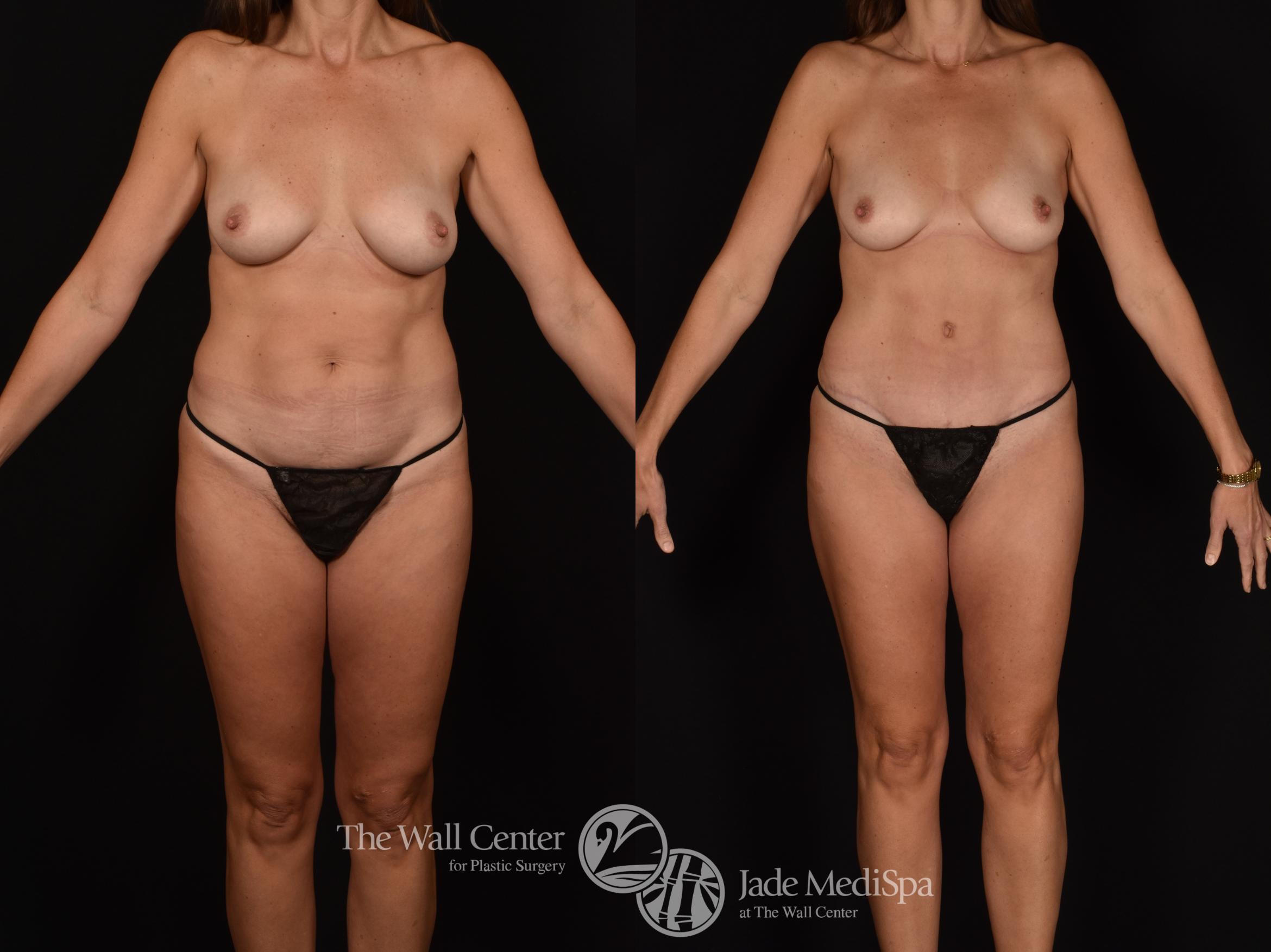 Before & After Tummy Tuck Case 1258 Front View in Shreveport, LA