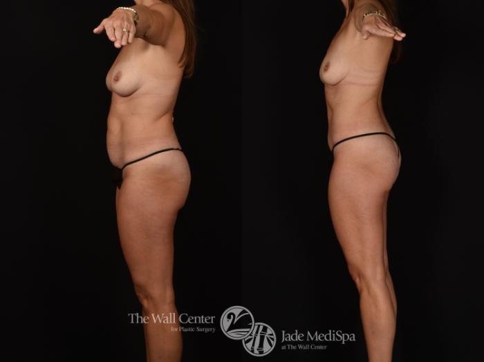 Before & After Tummy Tuck Case 1258 Left Side View in Shreveport, LA