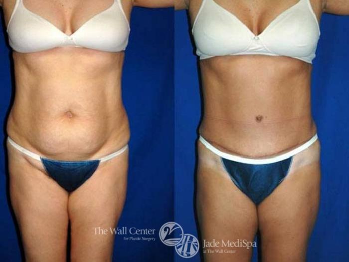 Before & After Tummy Tuck Case 148 View #1 View in Shreveport, LA