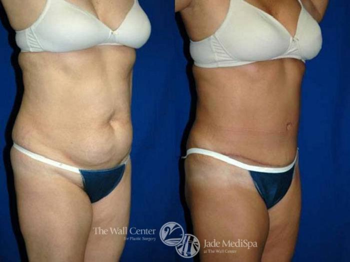 Before & After Tummy Tuck Case 148 View #2 View in Shreveport, LA