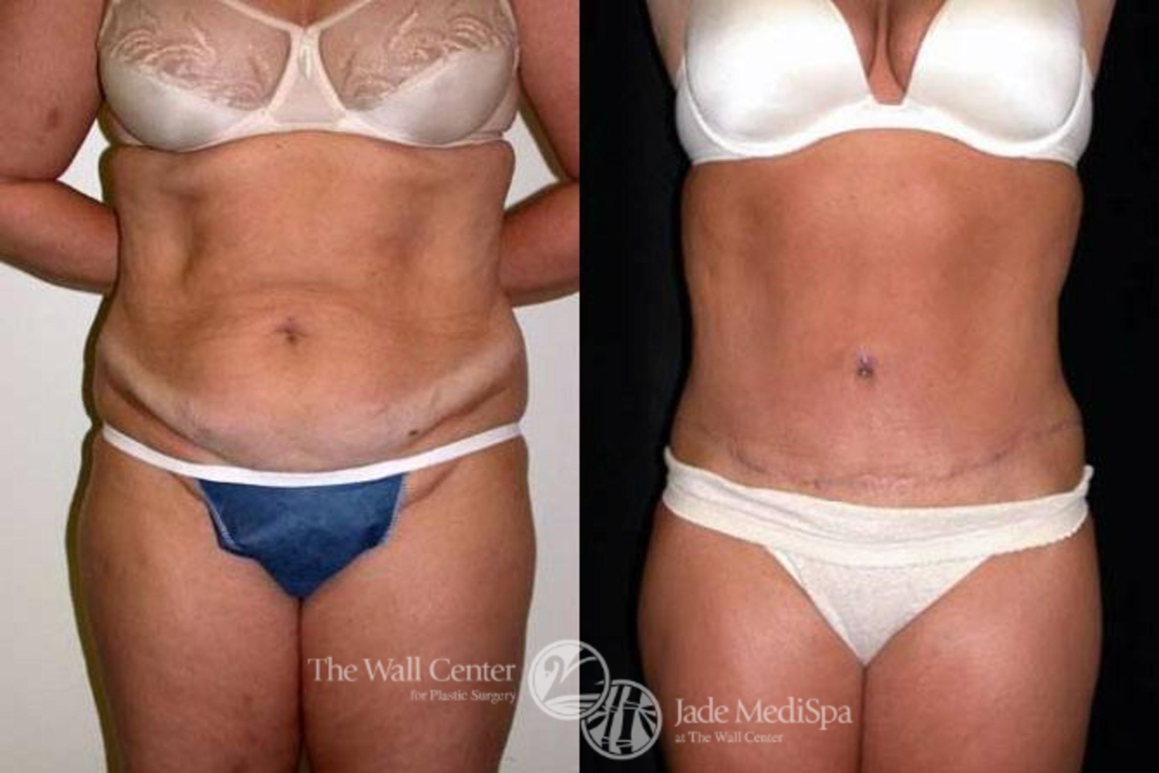 Before & After Tummy Tuck Case 150 View #1 View in Shreveport, LA