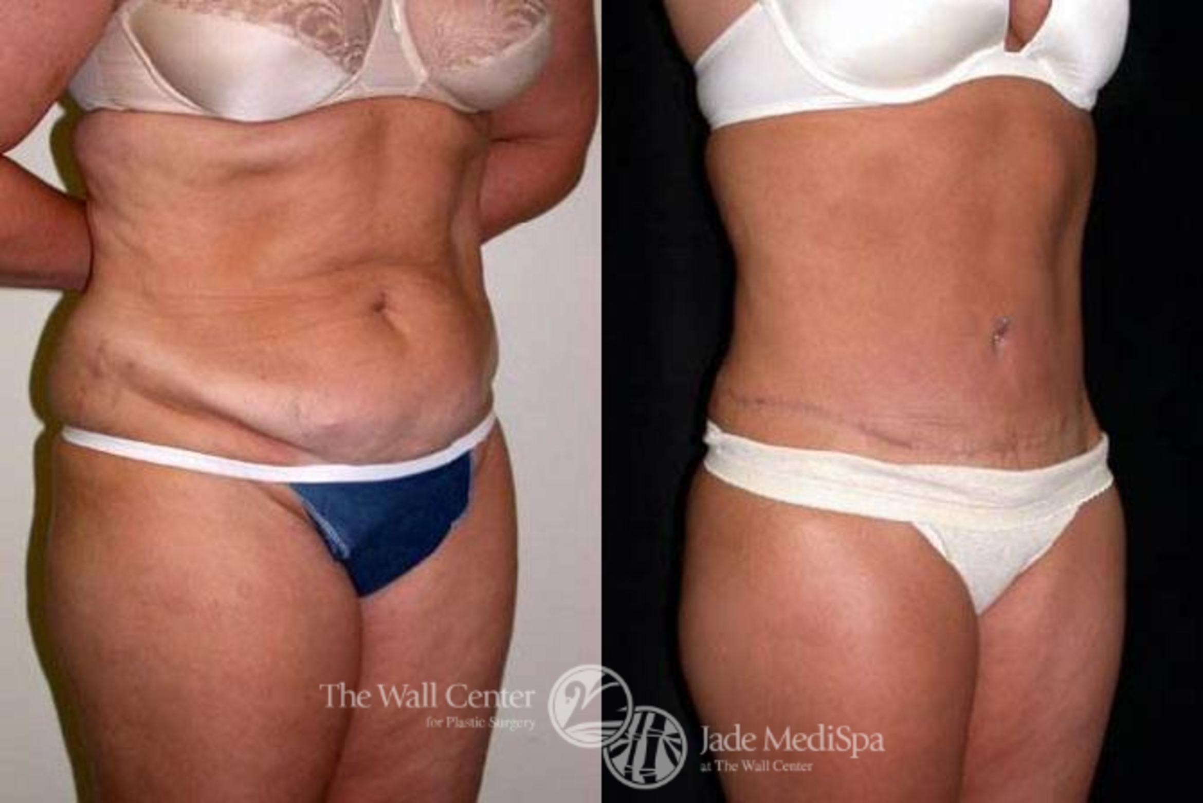 Before & After Tummy Tuck Case 150 View #2 View in Shreveport, LA