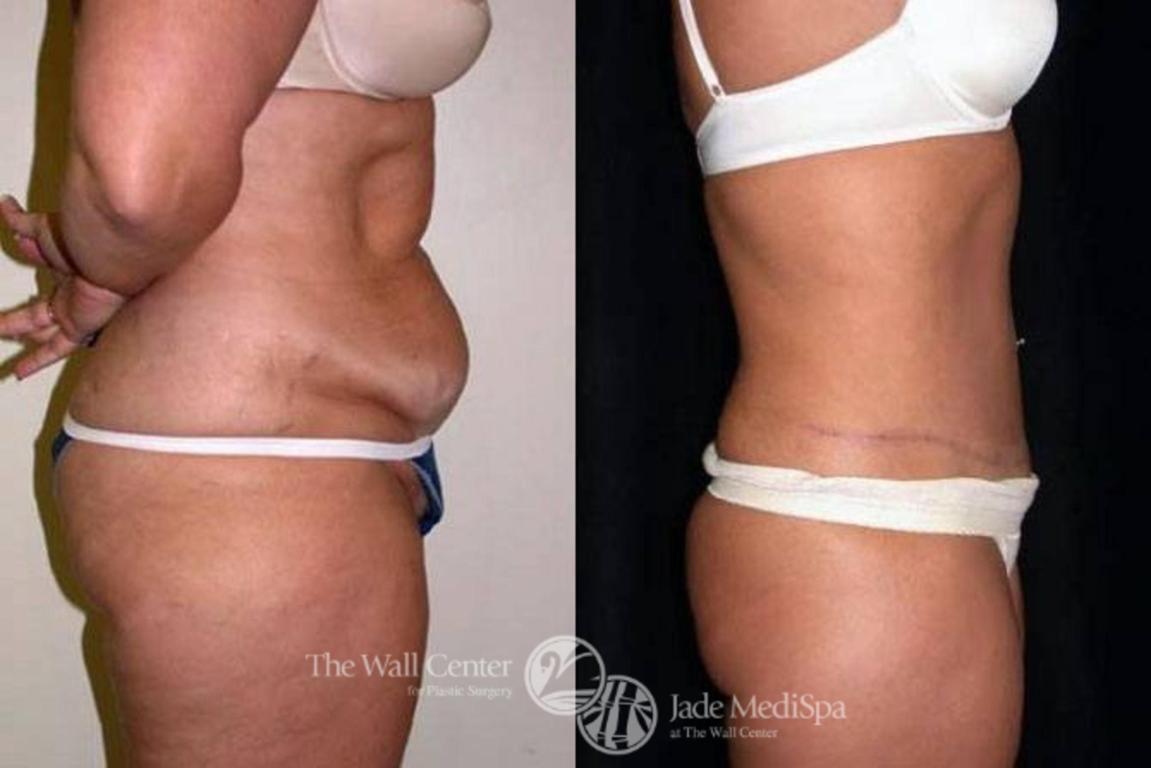 Before & After Tummy Tuck Case 150 View #3 View in Shreveport, LA