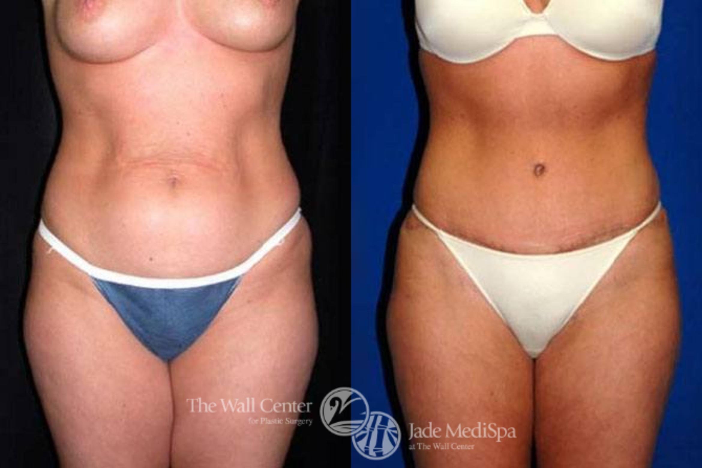 Before & After Tummy Tuck Case 152 View #1 View in Shreveport, LA