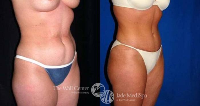 Before & After Tummy Tuck Case 152 View #2 View in Shreveport, LA