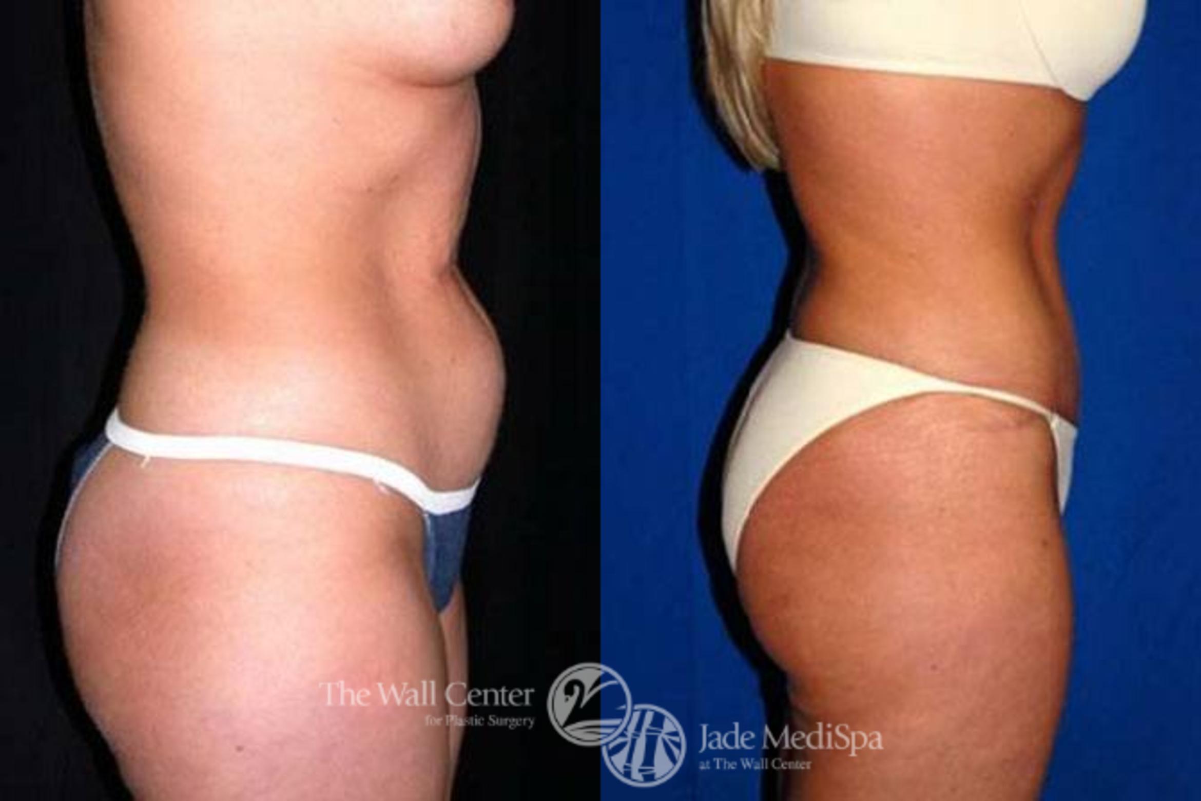 Before & After Tummy Tuck Case 152 View #3 View in Shreveport, LA