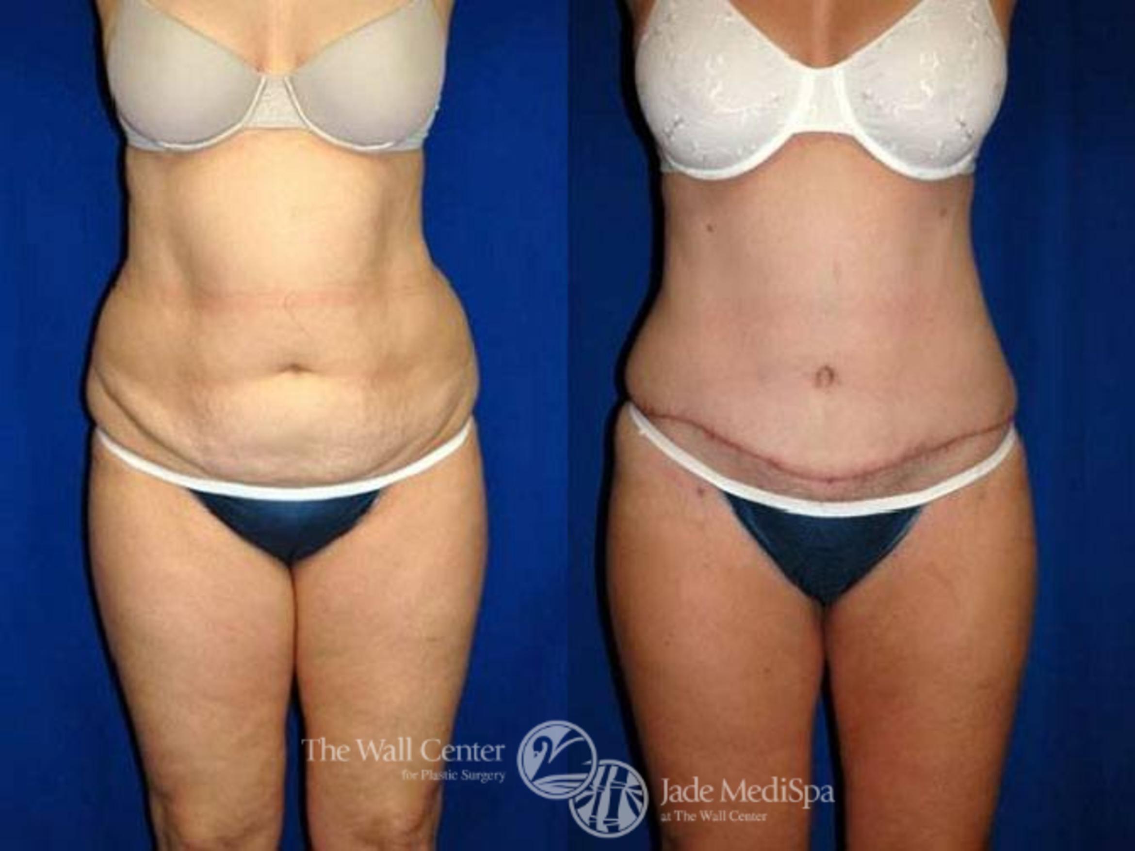 Before & After Tummy Tuck Case 153 View #1 View in Shreveport, LA