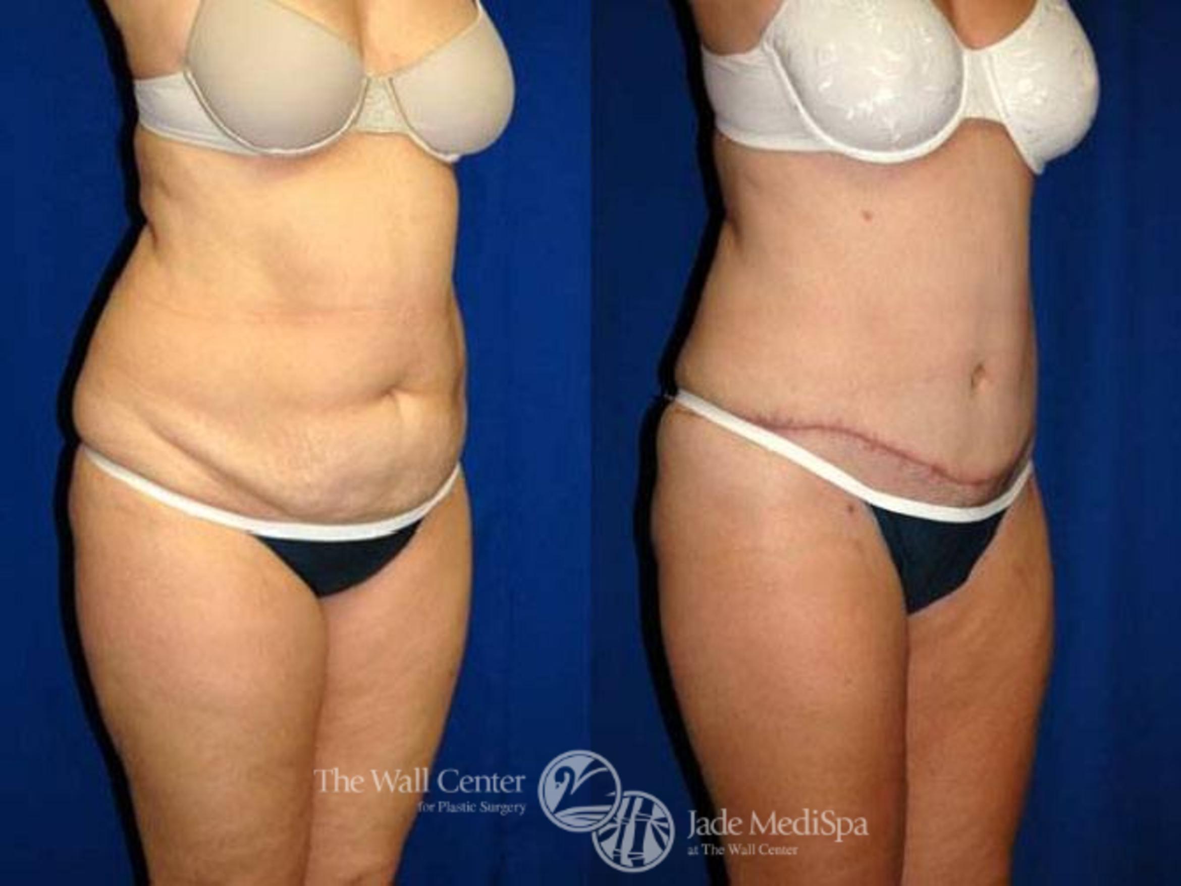 Before & After Tummy Tuck Case 153 View #2 View in Shreveport, LA