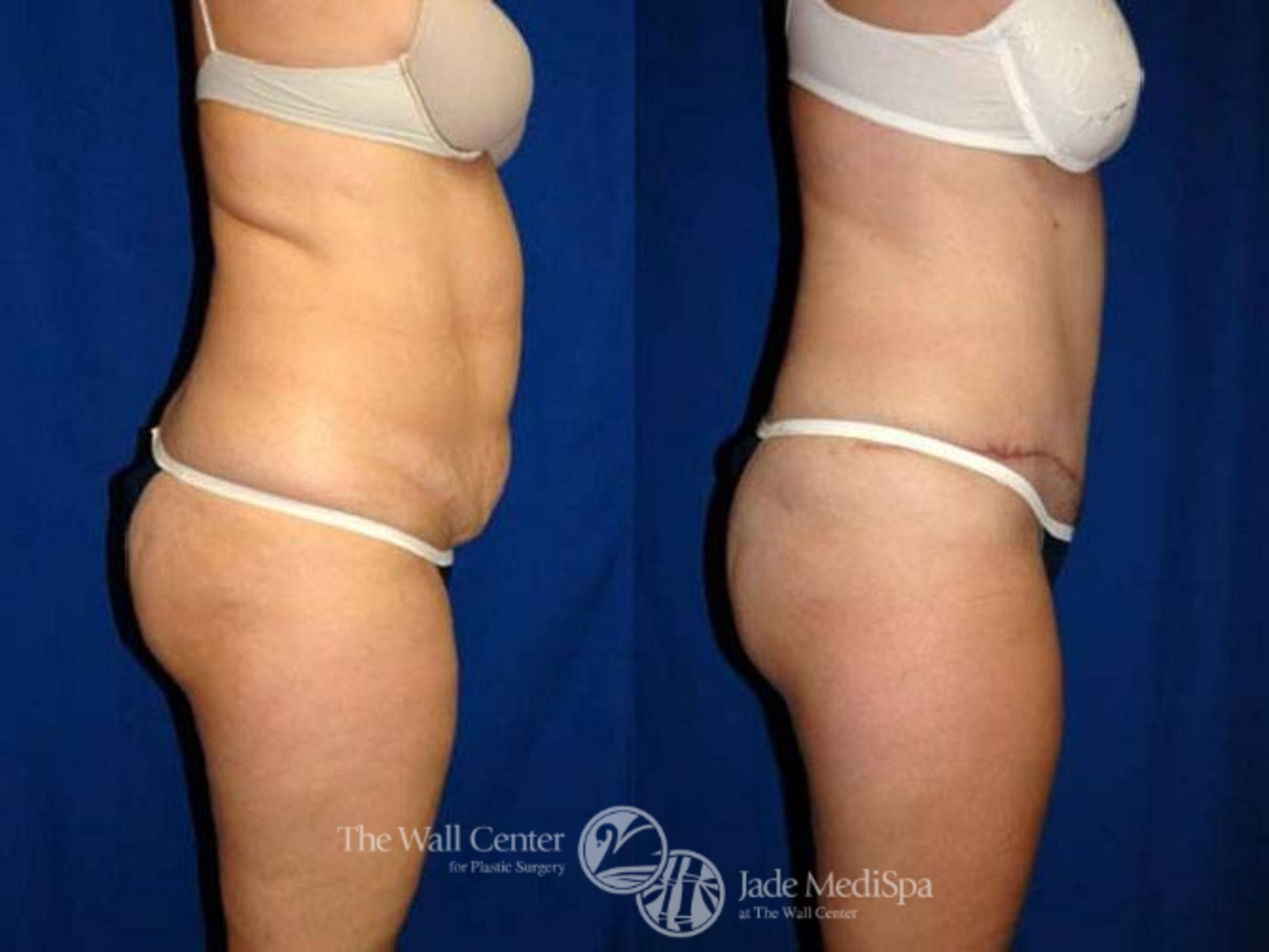 Before & After Tummy Tuck Case 153 View #3 View in Shreveport, LA