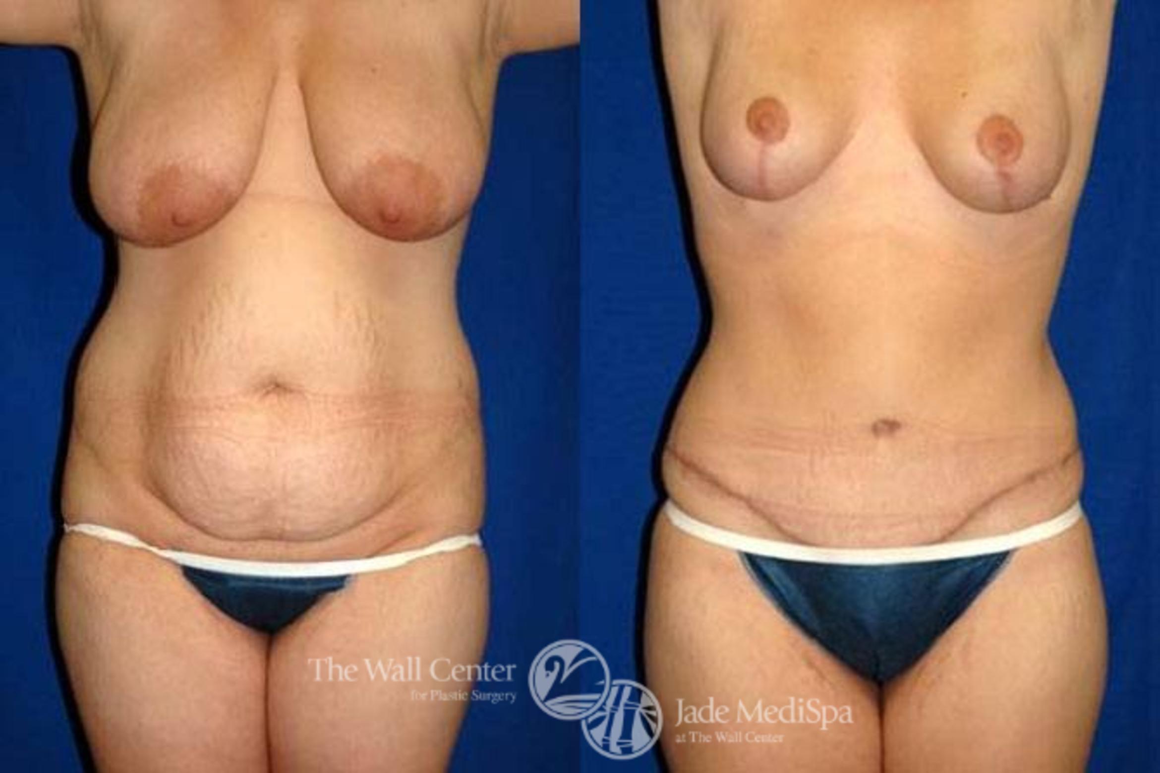 Before & After Breast Lift Case 155 View #1 View in Shreveport, LA