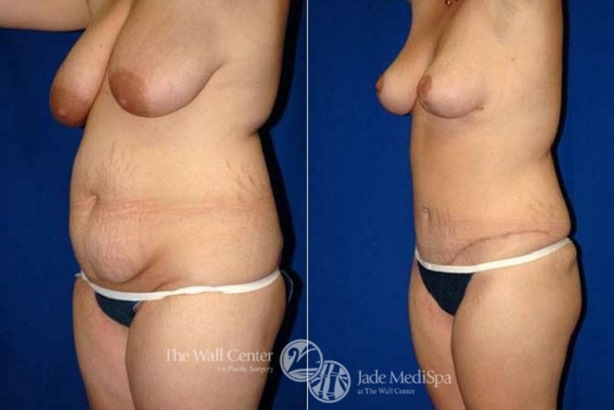 Before & After Tummy Tuck Case 155 View #2 View in Shreveport, LA