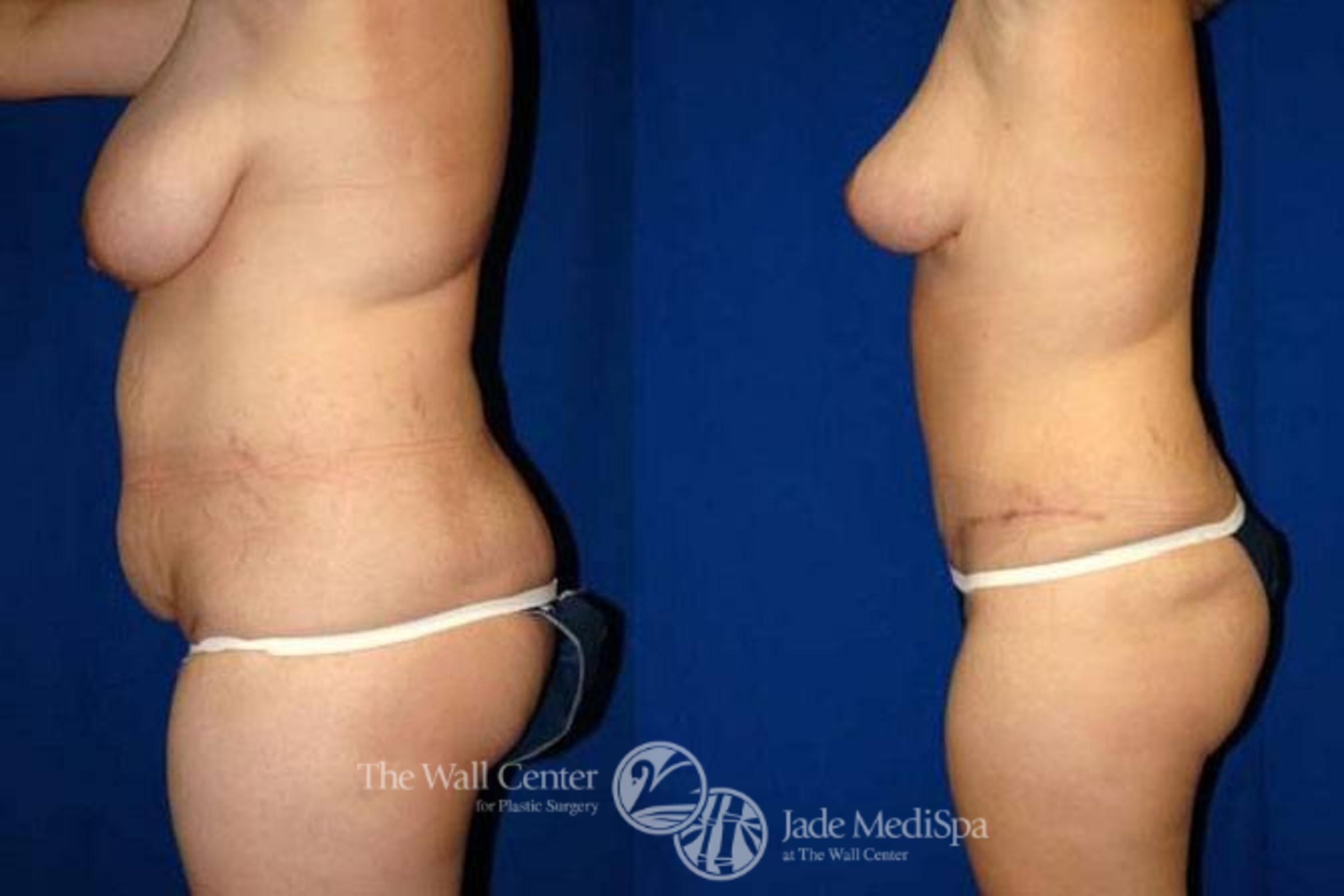 Before & After SAFELipo™ Case 155 View #3 View in Shreveport, LA