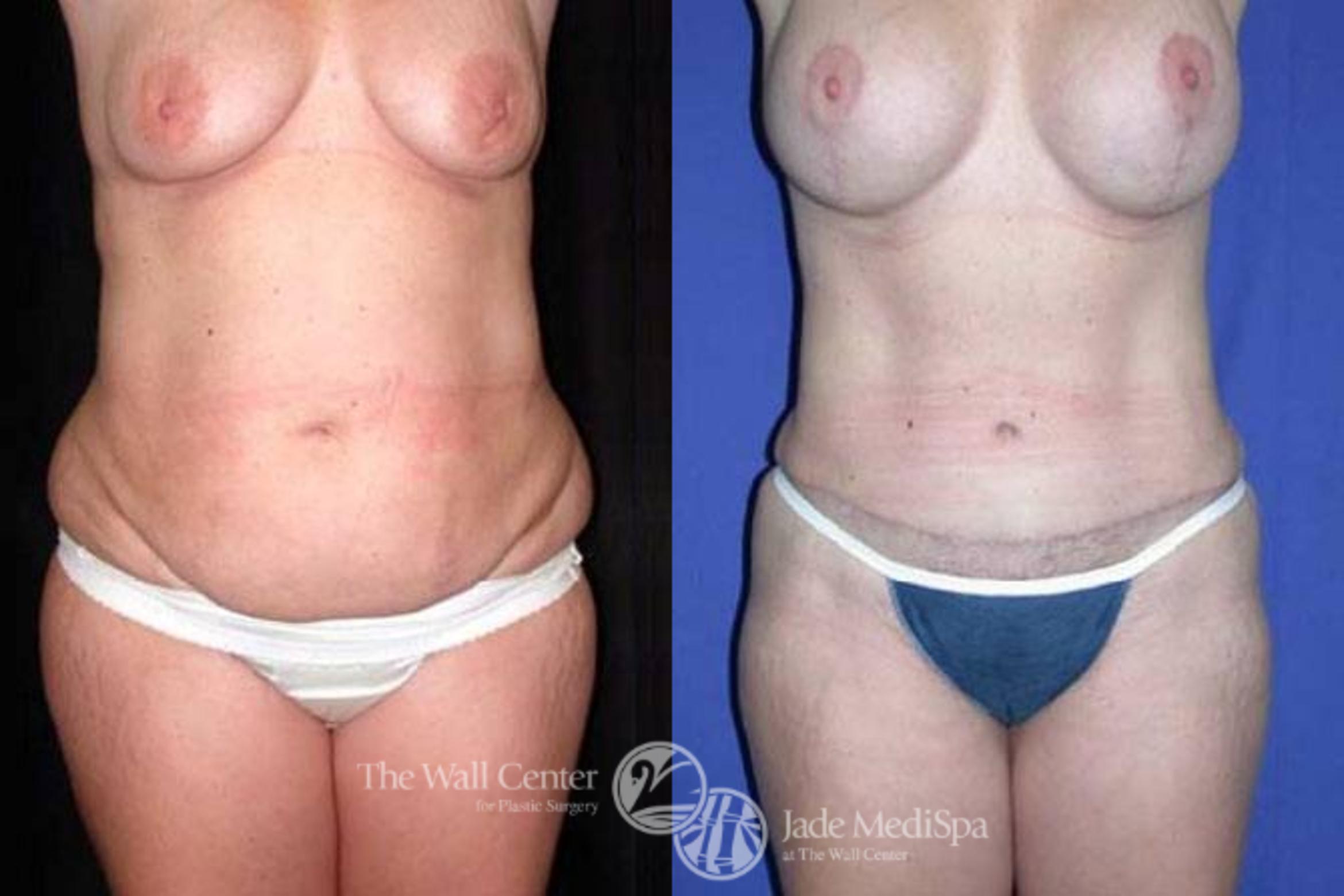 Before & After Tummy Tuck Case 156 View #1 View in Shreveport, LA