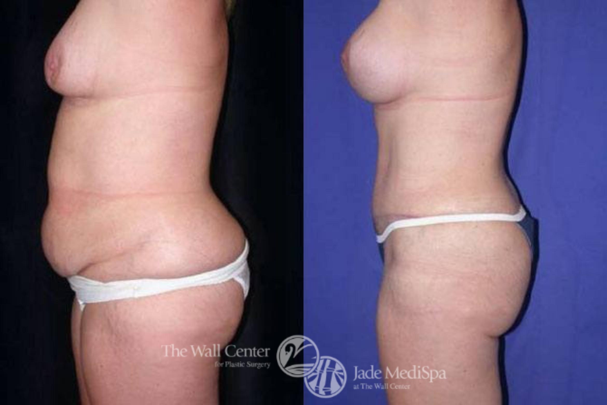 Before & After Tummy Tuck Case 156 View #3 View in Shreveport, LA