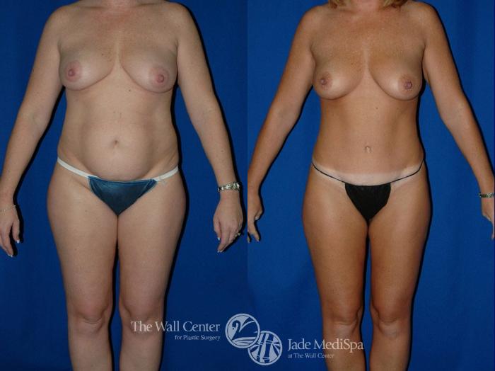 Before & After Tummy Tuck Case 16 View #2 View in Shreveport, LA