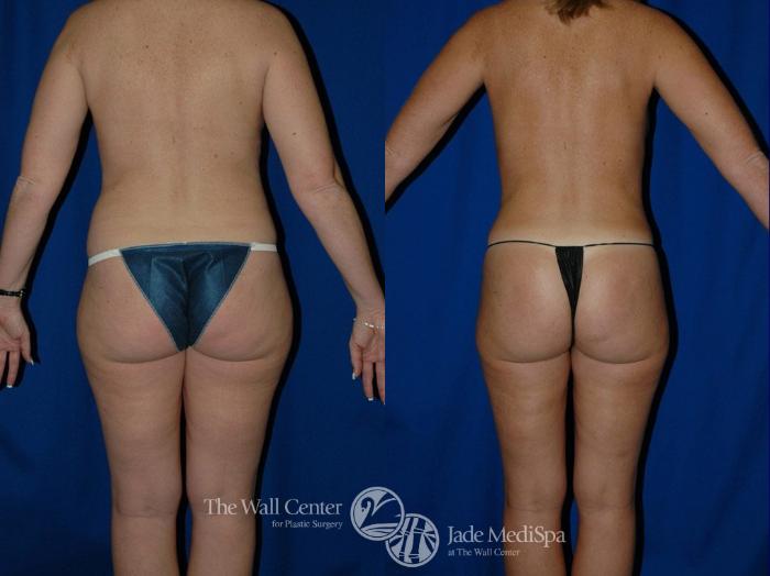 Before & After Tummy Tuck Case 16 View #4 View in Shreveport, LA