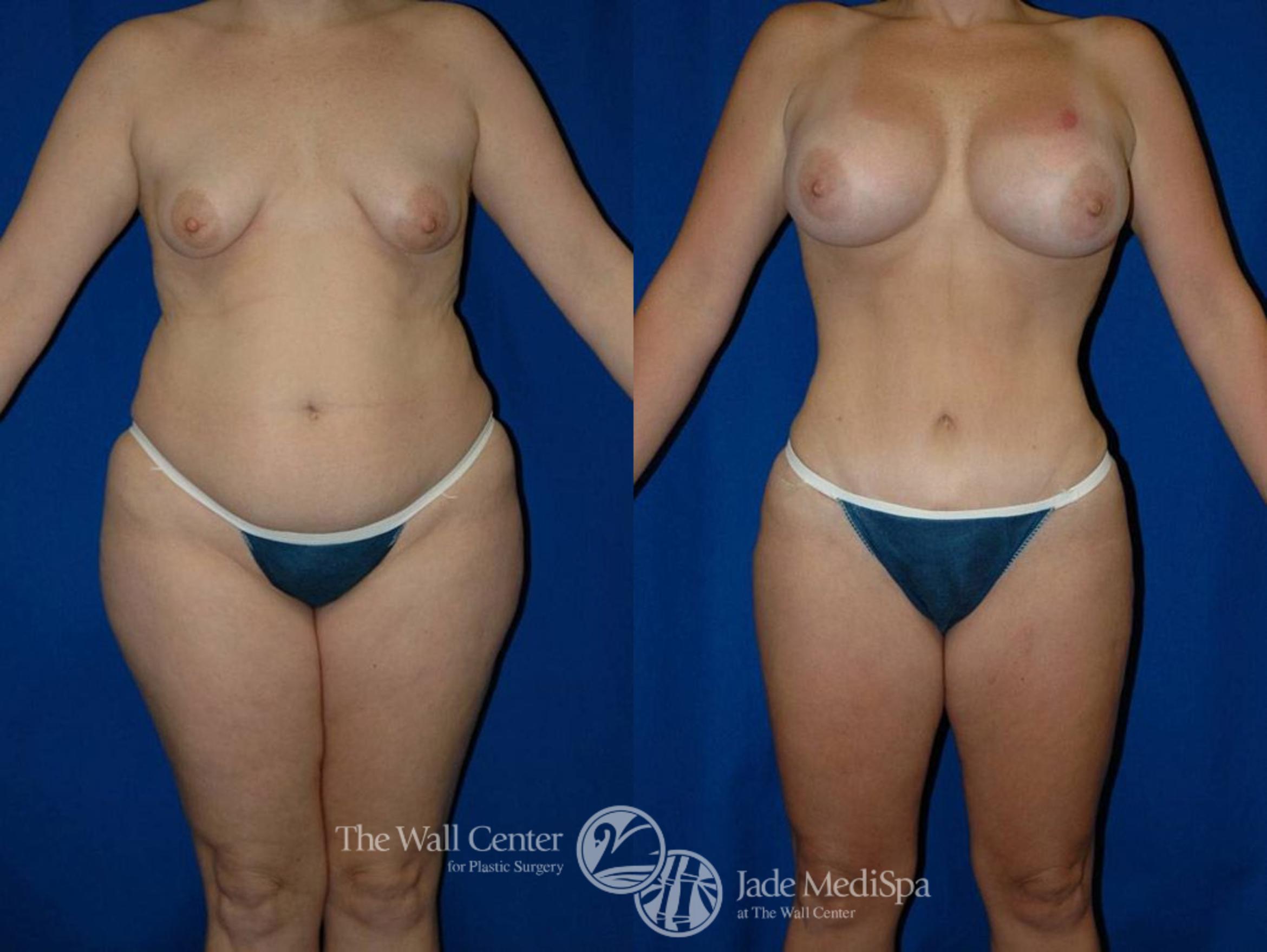 Before & After Tummy Tuck Case 17 View #1 View in Shreveport, LA