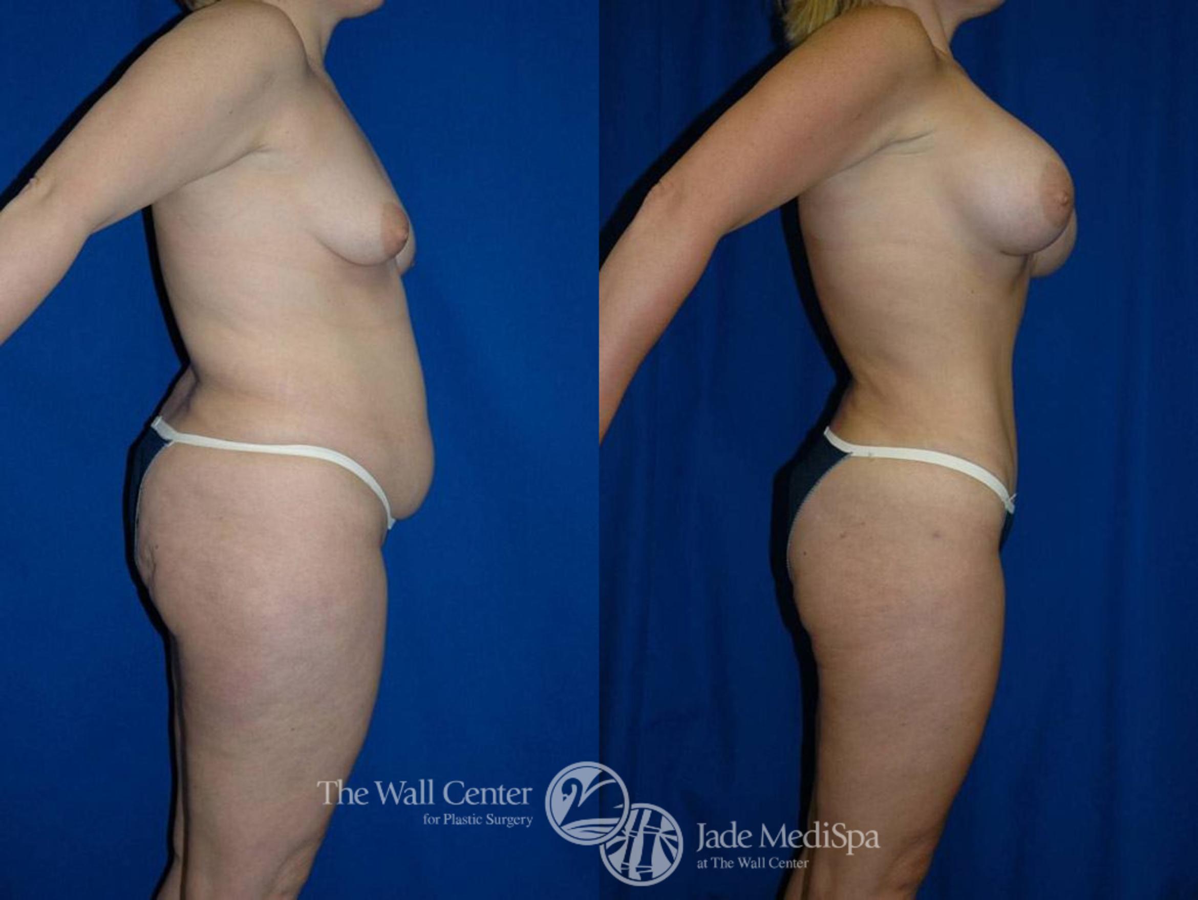 Before & After Tummy Tuck Case 17 View #3 View in Shreveport, LA