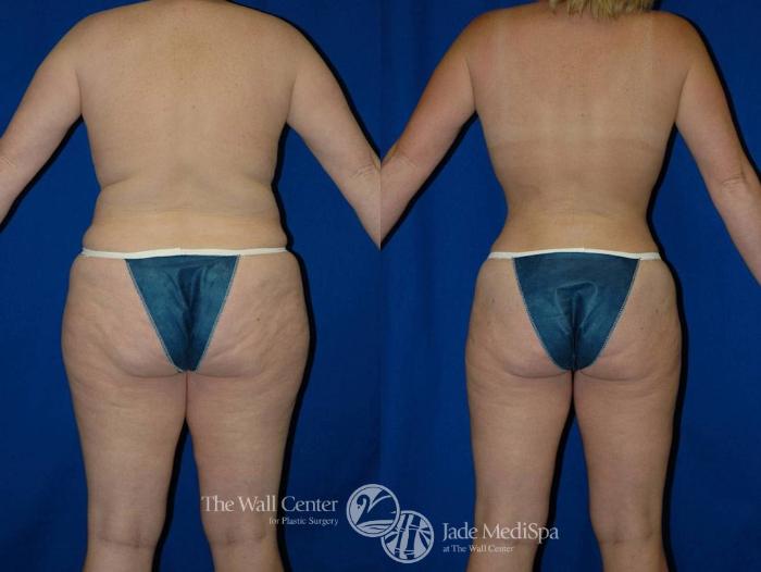 Before & After Tummy Tuck Case 17 View #4 View in Shreveport, LA
