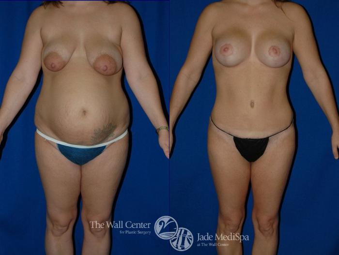 Before & After Tummy Tuck Case 18 View #1 View in Shreveport, LA