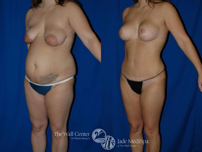 Before & After Tummy Tuck Case 18 View #2 View in Shreveport, LA