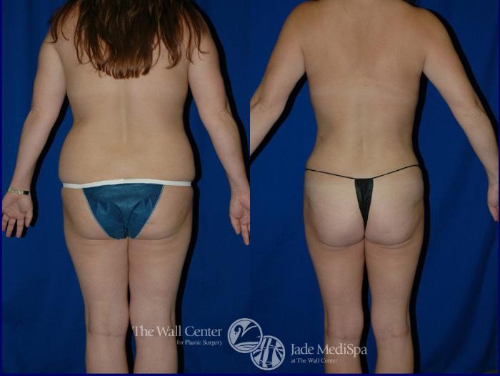 Before & After Tummy Tuck Case 18 View #4 View in Shreveport, LA