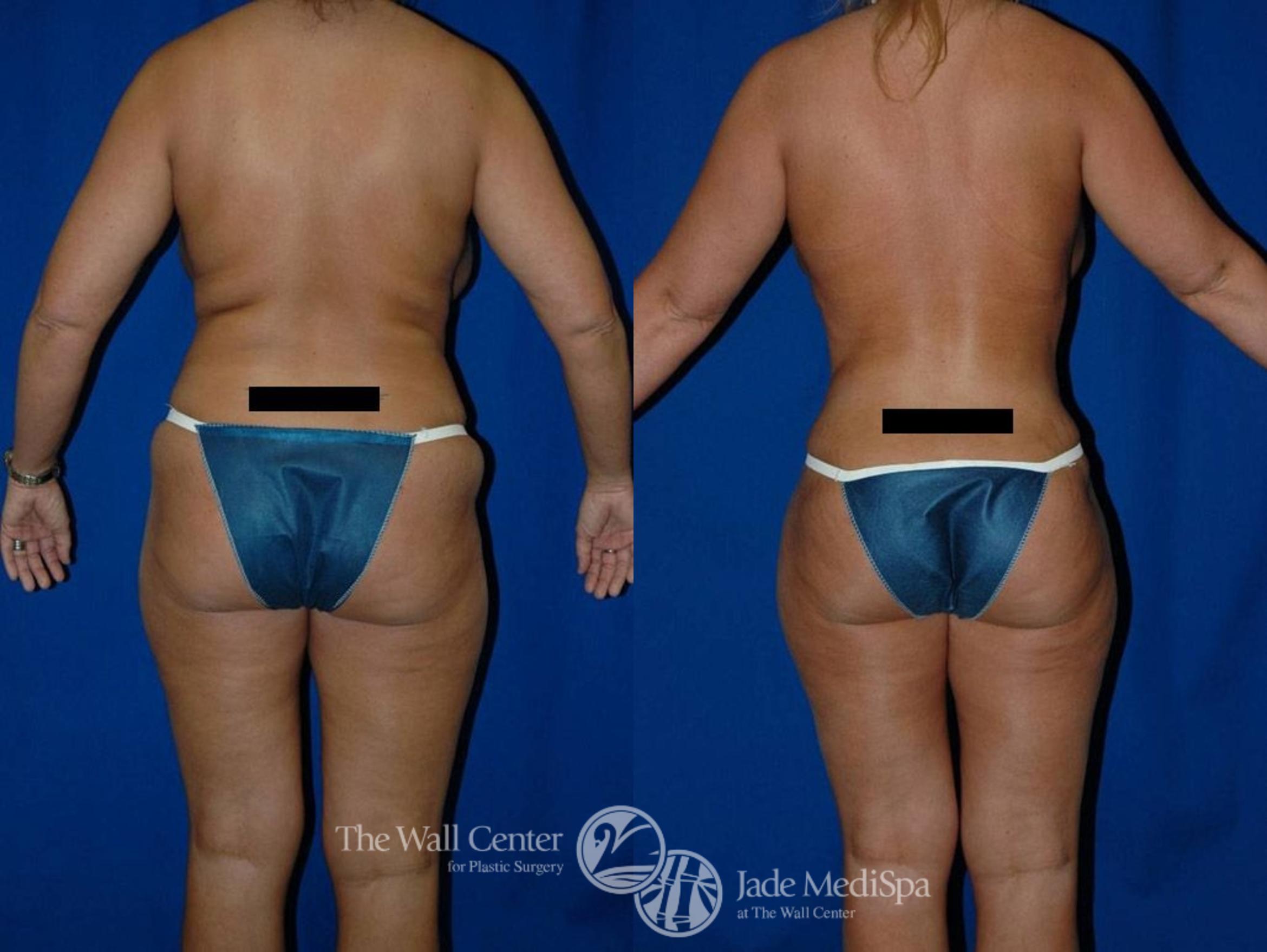 Abdominoplasty with SAFELipo Front Photo, Shreveport, LA, The Wall Center for Plastic Surgery, Case 19