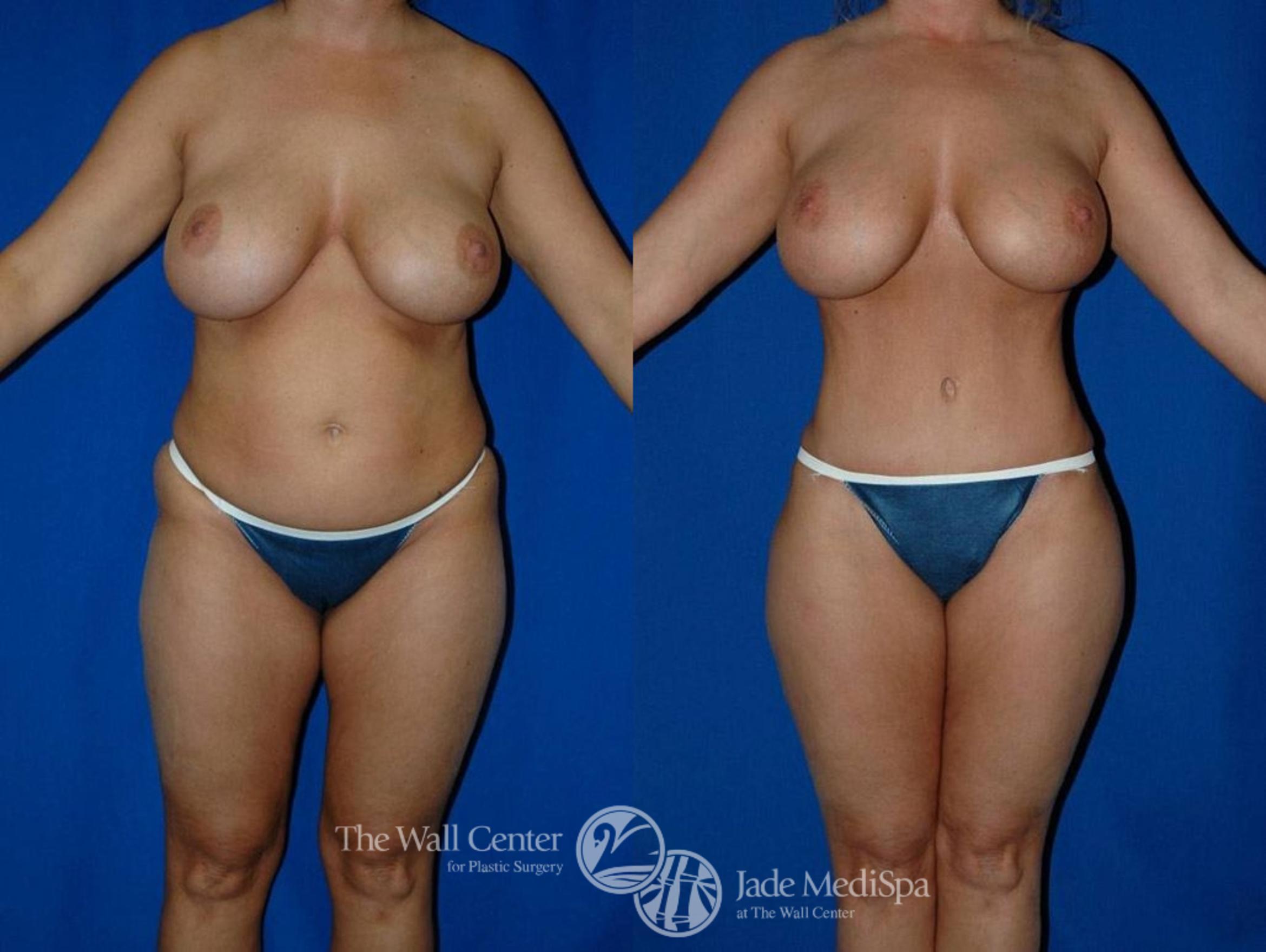 Abdominoplasty with SAFELipo Front Photo, Shreveport, LA, The Wall Center for Plastic Surgery, Case 19