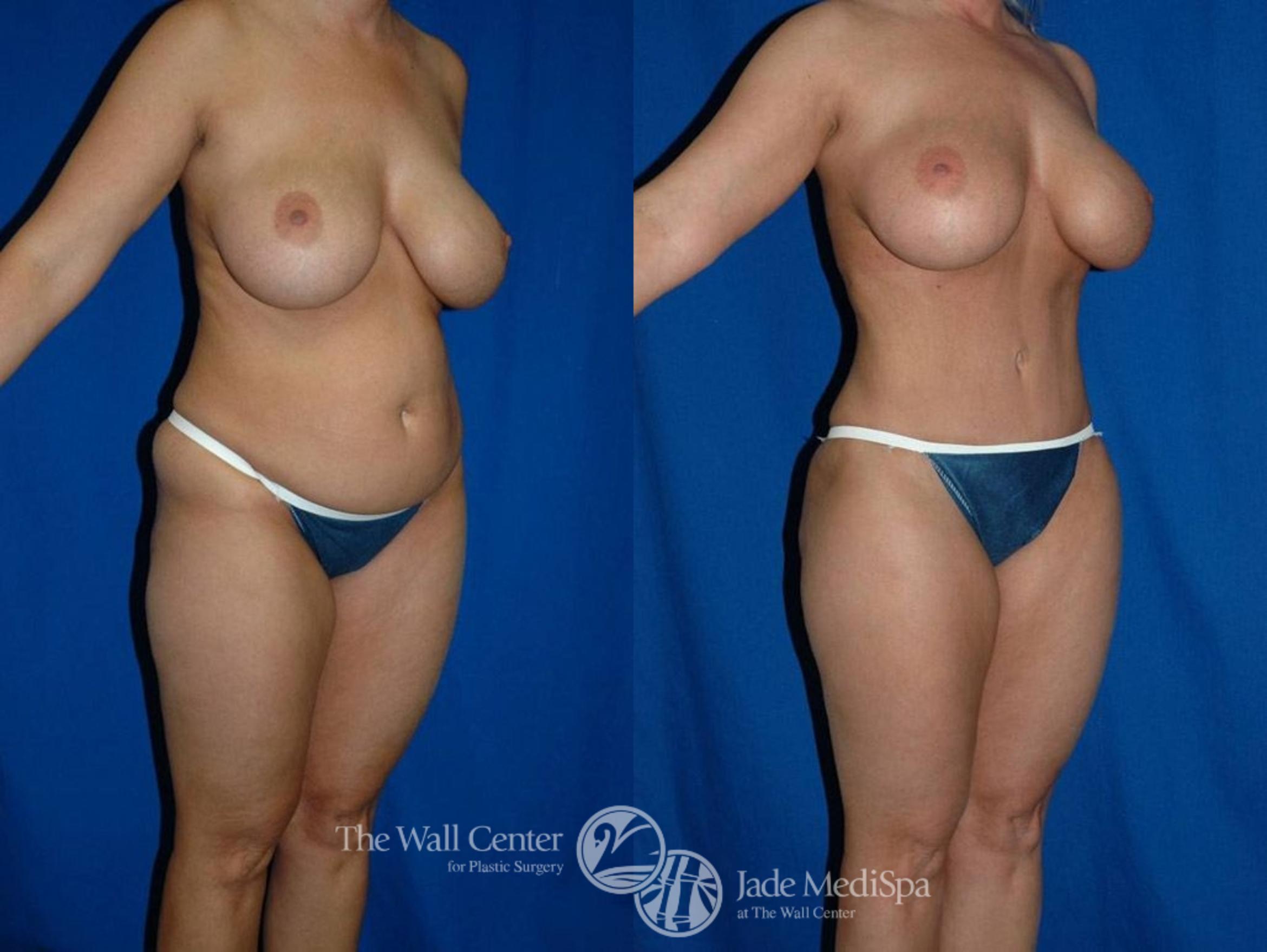 Abdominoplasty with SAFELipo Front Photo, Shreveport, LA, The Wall Center for Plastic Surgery, Case 19