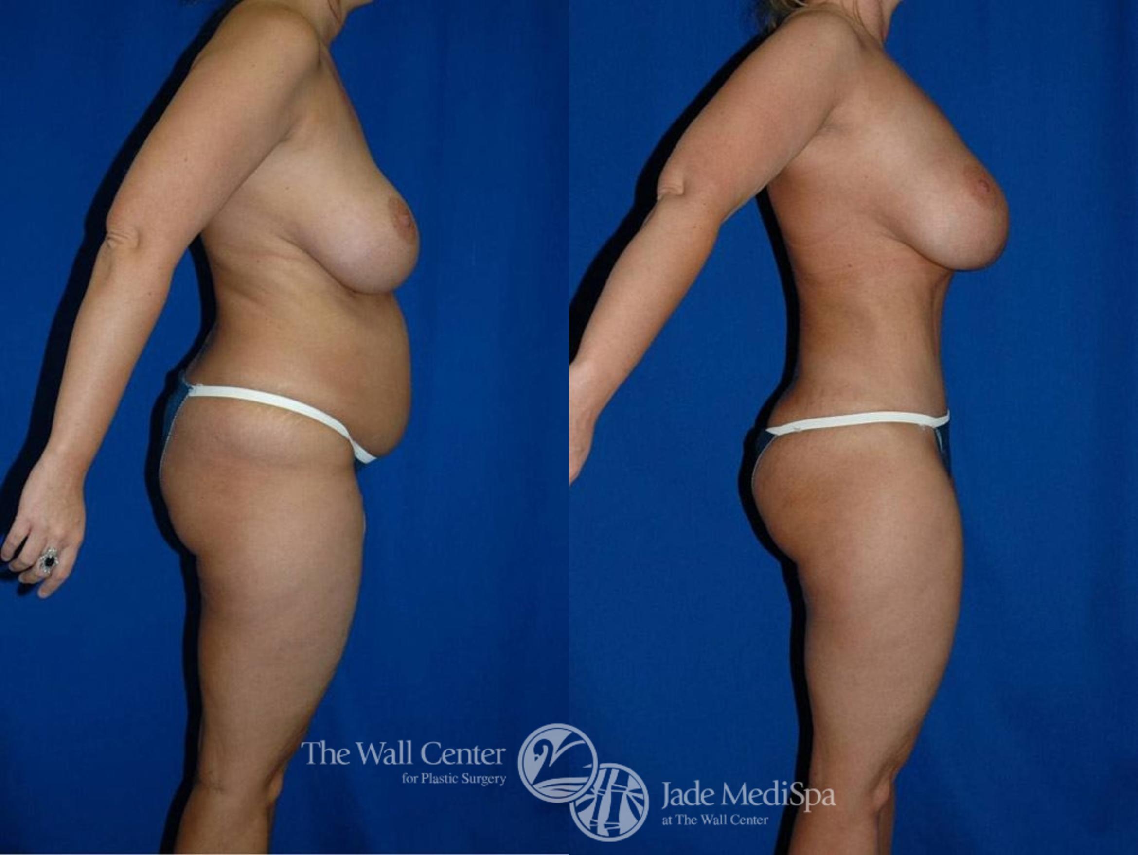 Abdominoplasty with SAFELipo Front Photo, Shreveport, LA, The Wall Center for Plastic Surgery, Case 19