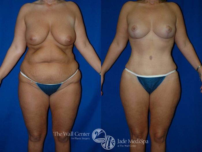 Before & After Tummy Tuck Case 20 View #1 View in Shreveport, LA