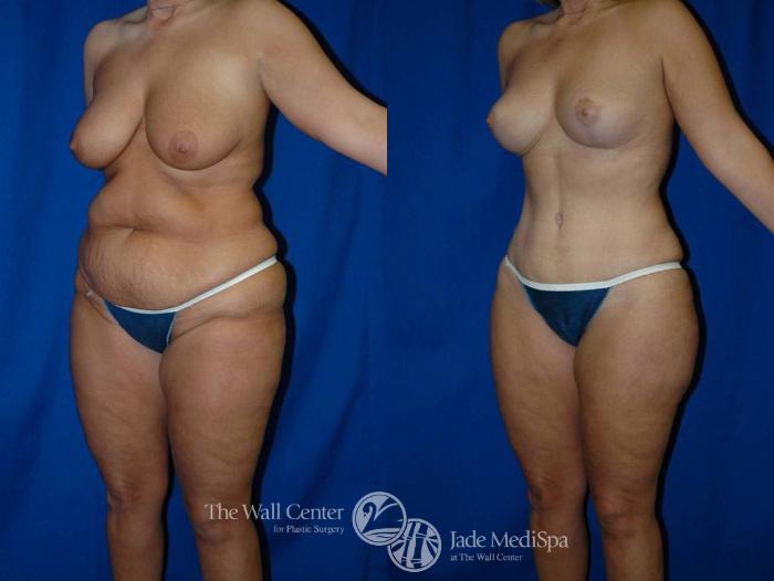 Before & After Tummy Tuck Case 20 View #2 View in Shreveport, LA