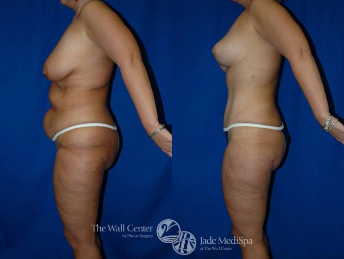 Before & After Tummy Tuck Case 20 View #3 View in Shreveport, LA