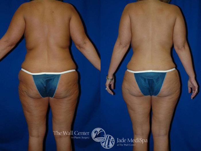 Before & After Tummy Tuck Case 20 View #4 View in Shreveport, LA